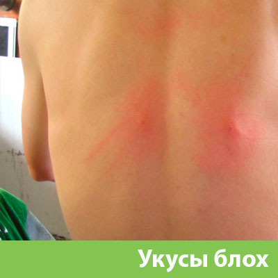Укусы блох в Новочебоксарске