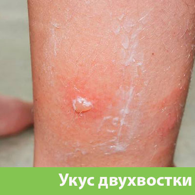 Укус двухвостки в Новочебоксарске