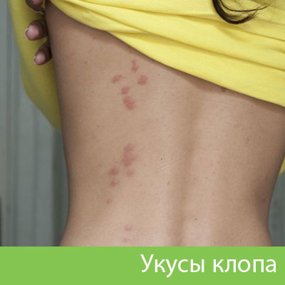 Профессиональное уничтожение клопов в Новочебоксарске